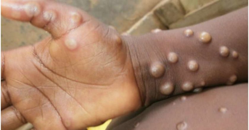 African States Report 1,400 Monkeypox Cases – WHO